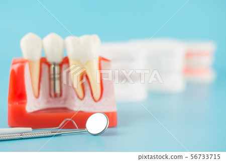 Dental implant model in dental concept. Dental implant model in dental concept. 56733715