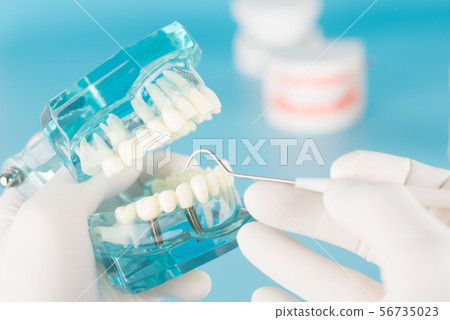 Dental implant check up by dentist. 56735023