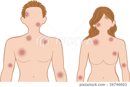 Purulent upper body, front and back Purulent upper body, front and back 56746603