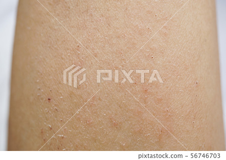 皮炎乾燥皮疹濕疹疼痛粗糙皮膚發癢癢手臂汗汗汗蟲咬傷皮膚 56746703