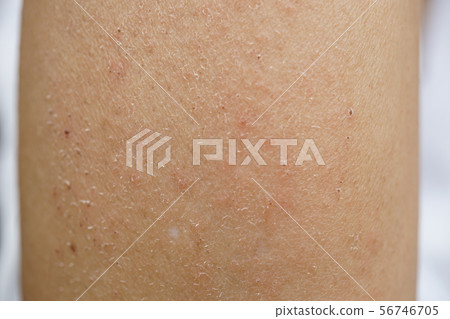 皮炎乾燥皮疹濕疹疼痛粗糙皮膚發癢癢手臂汗汗汗蟲咬傷皮膚 皮炎乾燥皮疹濕疹疼痛粗糙皮膚發癢癢手臂汗汗汗蟲咬傷皮膚 56746705