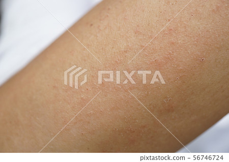 Insect bites Dermatitis Rough skin Eczema Dry rash Itchy Itchy Arms People Ashmo Sweat Skin 56746724