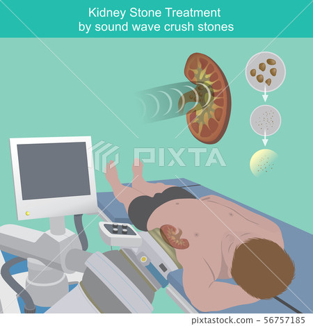 Kidney Stone Treatment. Kidney Stone Treatment. 56757185