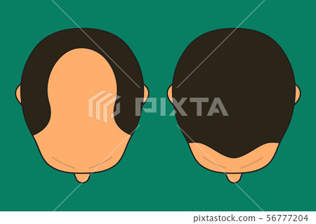 male with bald head 56777204