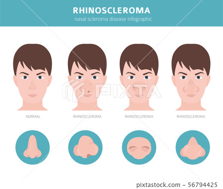 Nasal diseases. Rhinoscleroma symptoms, nasal 56794425