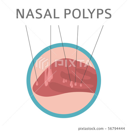 Nasal diseases. Nasal polyps causes, diagnosis and Nasal diseases. Nasal polyps causes, diagnosis and 56794444