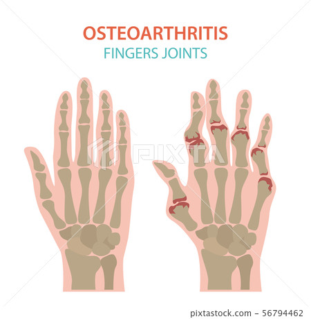 Arthritis, osteoarthritis medical infographic 56794462