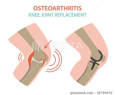 Arthritis, osteoarthritis medical infographic 56794470