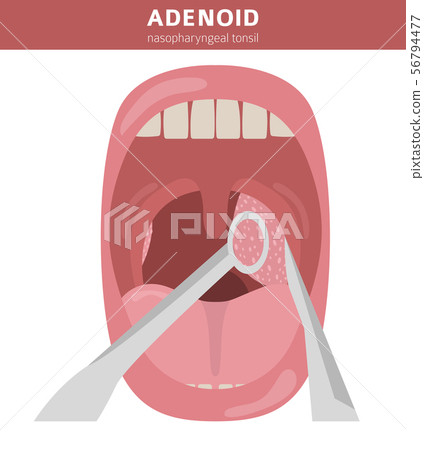 Nasal and throat, nasopharynx diseases. Adenoids 56794477
