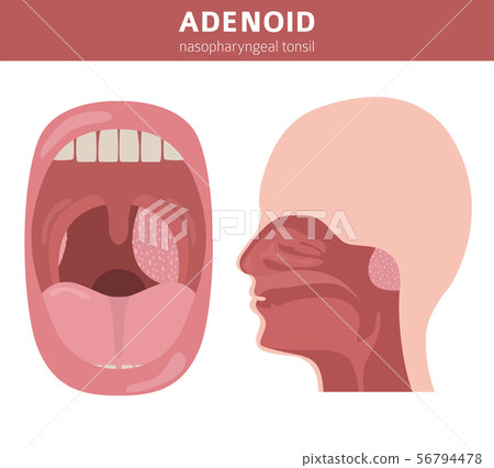 Nasal and throat, nasopharynx diseases. Adenoids Nasal and throat, nasopharynx diseases. Adenoids 56794478