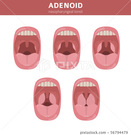 Nasal and throat, nasopharynx diseases. Adenoids 56794479