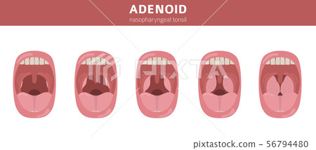Nasal and throat, nasopharynx diseases. Adenoids 56794480