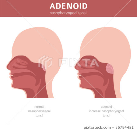 Nasal and throat, nasopharynx diseases. Adenoids Nasal and throat, nasopharynx diseases. Adenoids 56794481