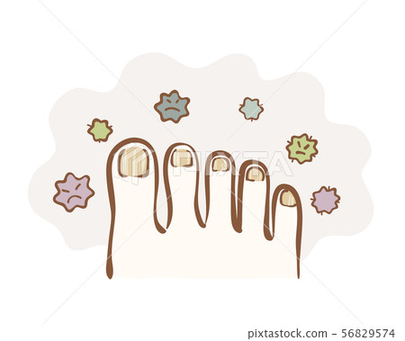 Illustration of a nail fungus Illustration of a nail fungus 56829574