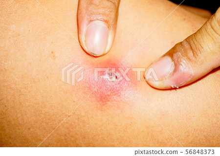 Acne skin problem on back side man surface Acne skin problem on back side man surface 56848373