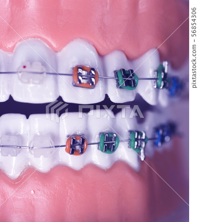 Dental brackets teeth straighteners 56854306