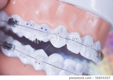 Dental brackets teeth straighteners 56854307