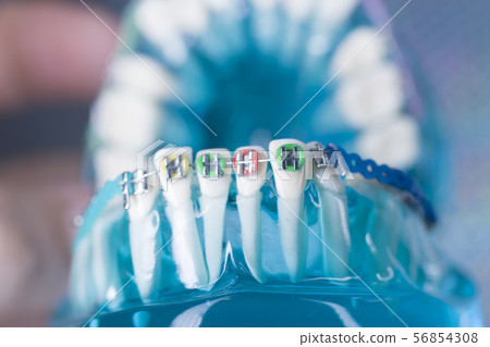 Dental brackets teeth straighteners 56854308