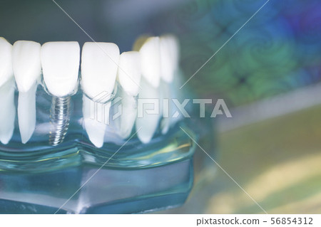 Dentist teeth implant dental model Dentist teeth implant dental model 56854312
