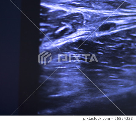 EPI dry needling ultrasound scan 56854328