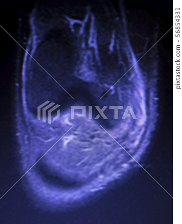 MRI knee meniscus tear scan MRI knee meniscus tear scan 56854331