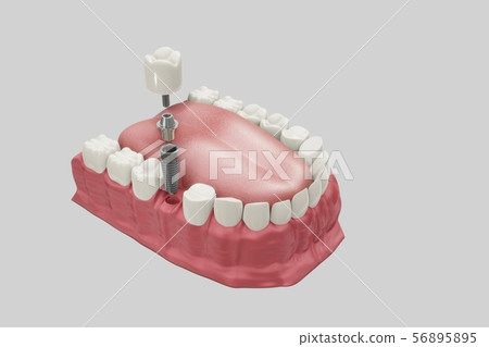 Dental Implants Treatment Procedure. Medically accurate 3D illustration dentures concept. 56895895