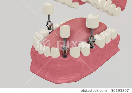 Dental Implants Treatment Procedure. Medically accurate 3D illustration dentures concept. 56895897