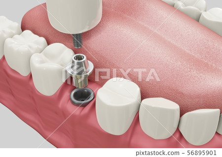 Dental Implants Treatment Procedure. Medically accurate 3D illustration dentures concept. 56895901