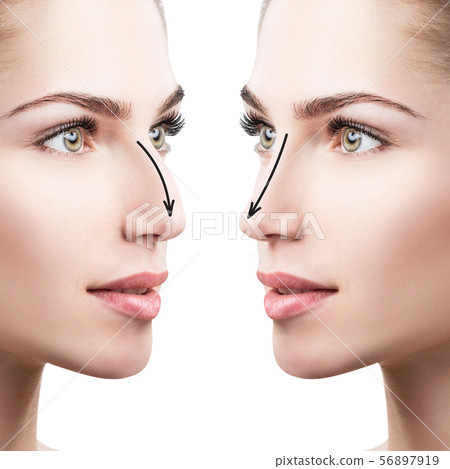 Female nose before and after cosmetic surgery. Female nose before and after cosmetic surgery. 56897919