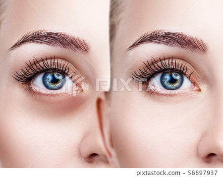 Female eyes with bruises under eyes before and after treatment. Female eyes with bruises under eyes before and after treatment. 56897937