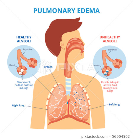 Pulmonary edema - respiratory lung disease... - Stock Illustration ...