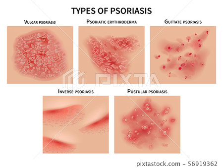Psoriasis types. Skin hives, derma diseases. Closeup medical vector illustration 56919362