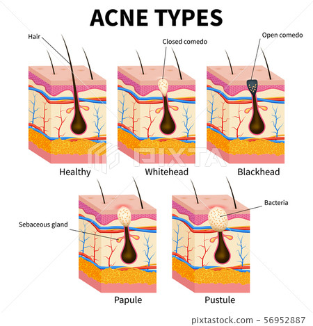 Acne types. Pimple skin diseases anatomy medical vector diagram Acne types. Pimple skin diseases anatomy medical vector diagram 56952887