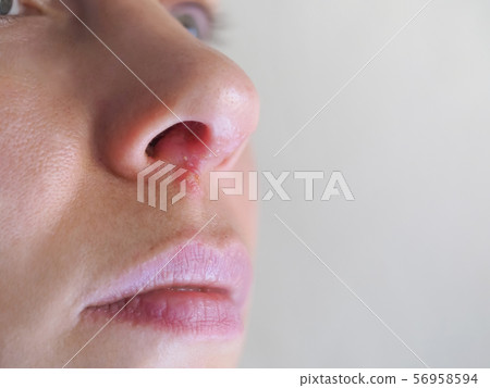 Herpes under the nose. Close up 56958594