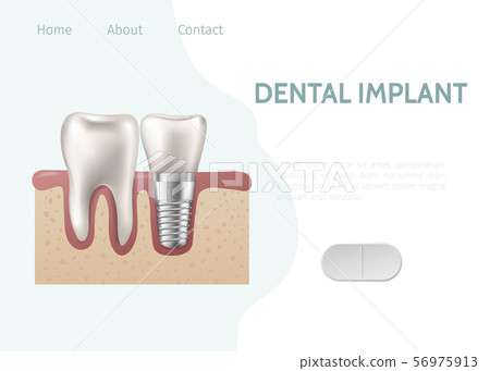 Implant and healthy tooth and structure vector illustration. Dental implant structure with all parts Implant and healthy tooth and structure vector illustration. Dental implant structure with all parts 56975913