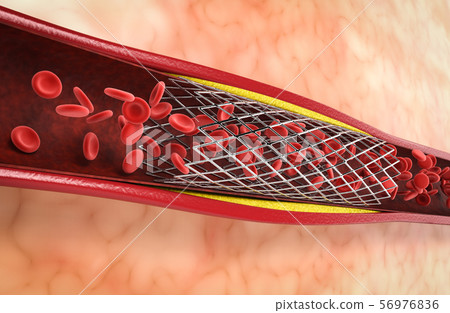 Balloon angioplasty procedure Balloon angioplasty procedure 56976836