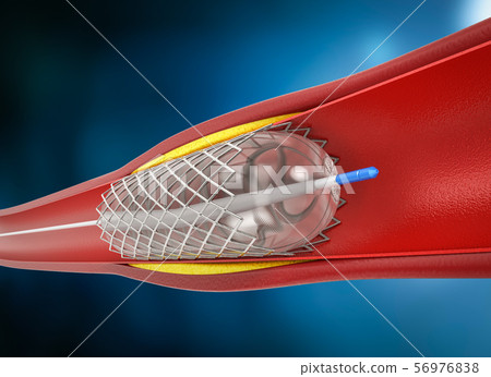 Balloon angioplasty procedure - Stock Illustration [56976838] - PIXTA