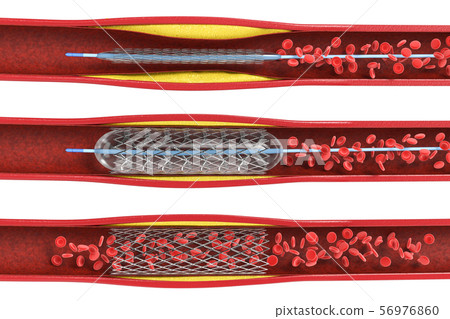 Balloon angioplasty procedure 56976860