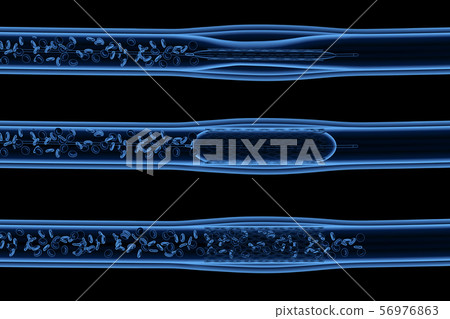 Balloon angioplasty procedure 56976863