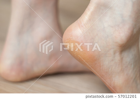 clavus and cracks on the heel of the foot clavus and cracks on the heel of the foot 57012201