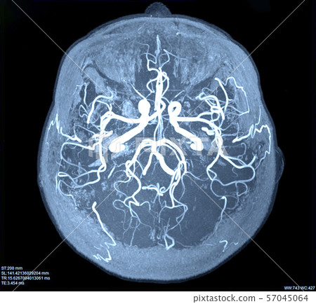 MRI of the blood vessels 57045064