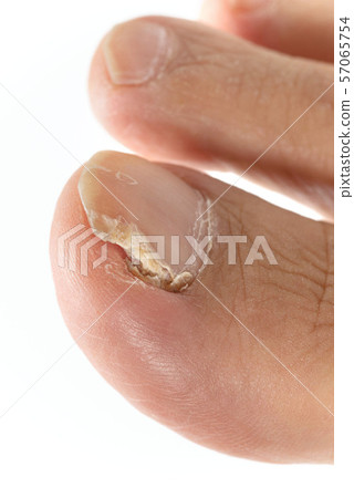 Nail athlete's foot 57065754