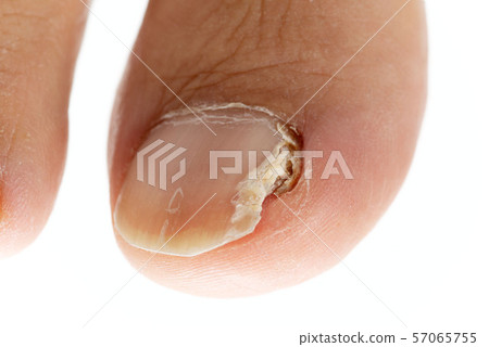 Nail athlete's foot 57065755