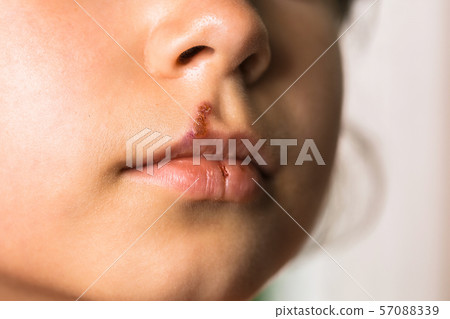 Herpes on upper lip of little girl. 57088339