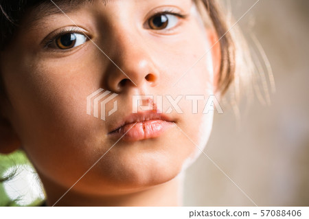 Child with cold sores on her lips. Child with cold sores on her lips. 57088406
