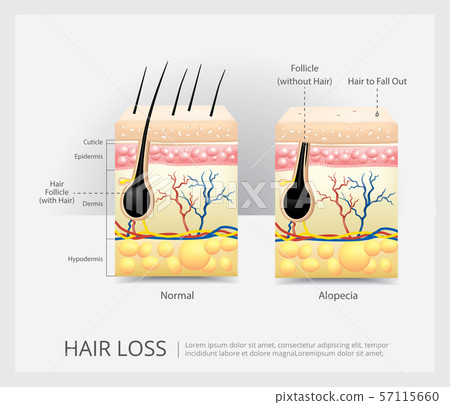 Hair Loss Structure Vector Illustration 57115660
