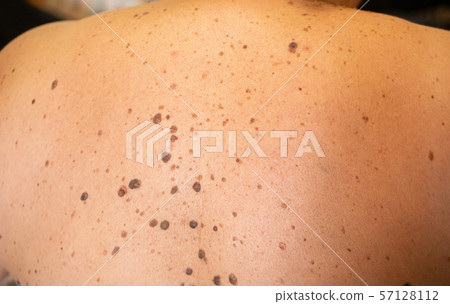 woman patient on clinical trials with lot on brown 57128112