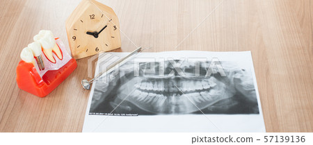 Implant dental model in dental care concept. Implant dental model in dental care concept. 57139136