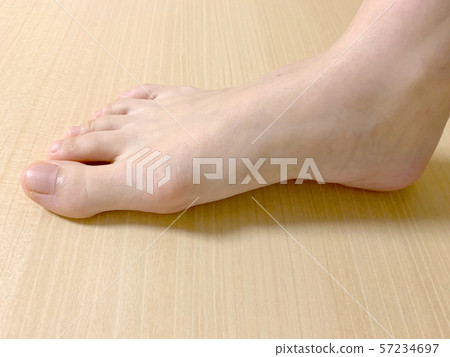 Right hallux valgus side 57234697