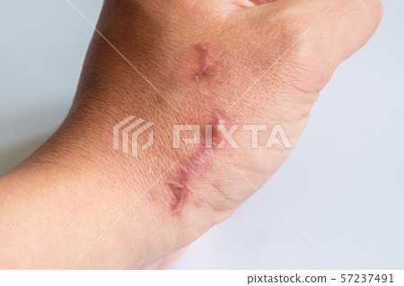 The scar on his arm near the wrist on a white 57237491